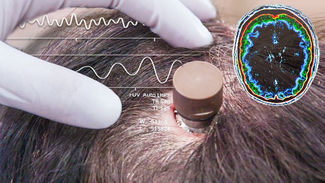 Người đàn ông bị liệt chỉnh sửa video, đăng YouTube 'chỉ bằng suy nghĩ': Ca cấy chip não Neuralink thứ ba gây chấn động- Ảnh 1.